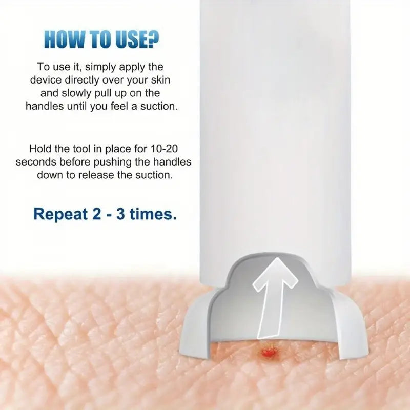 Portable Manual Vacuum Can Device for Mosquito Bites